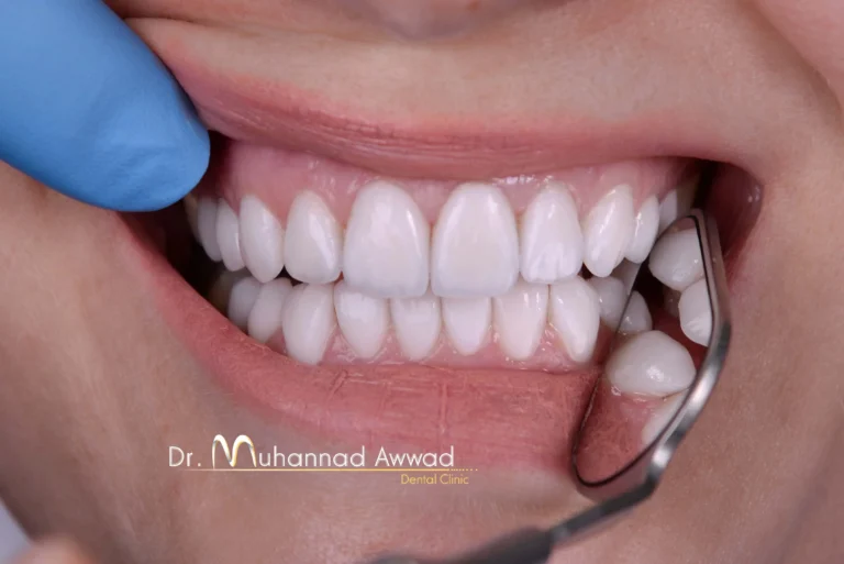 مركز د. مهند عواد - تجميل وزراعة الأسنان